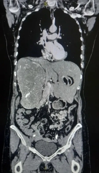 Волгоградские онкологи удалили крупную опухоль, сместившую печень пациента в другую часть тела